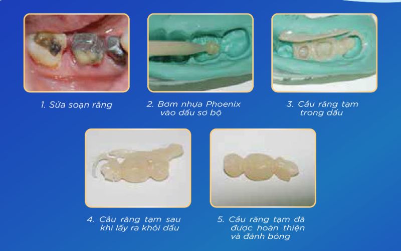 Quy trình sử dụng nhựa làm răng tạm Phoenix đạt hiệu quả cao nhất