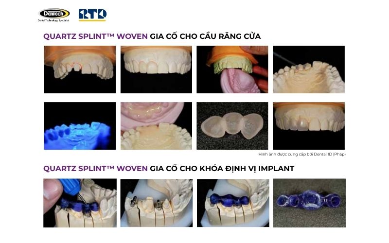 Ứng dụng lâm sàng của Quartz Splint Woven
