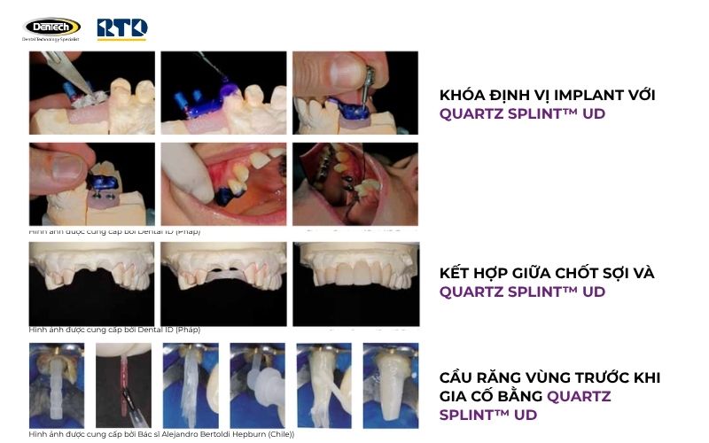 Ứng dụng lâm sàng của Quartz Splint UD
