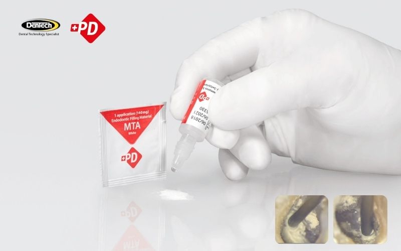 Hướng dẫn sử dụng xi măng nội nha PD MTA White
